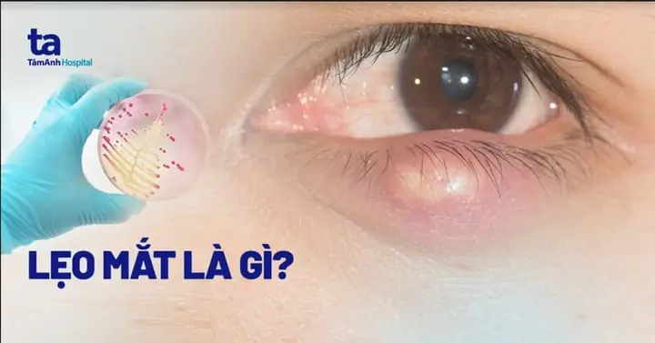 Nổi Mụt Lẹo Ở Mắt Phải Làm Sao? Hướng Dẫn Xử Lý Chi Tiết