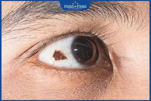 Nốt Ruồi Trong Mắt Ở Nam Giới: Nguyên Nhân, Cách Xử Lý Và Khi Nào Cần Đi Khám