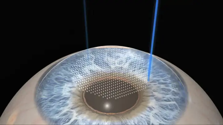 Phẫu Thuật Lasik: Ai Là Ứng Cử Viên Phù Hợp Nhất?