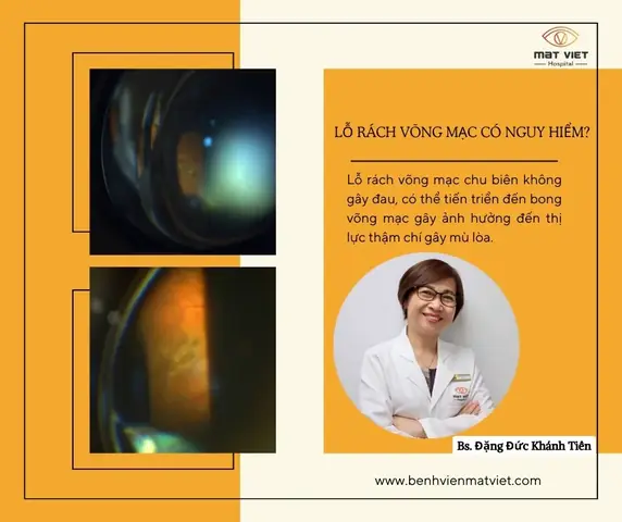 Rách Võng Mạc: Nguyên Nhân, Triệu Chứng Và Cách Xử Lý Hiệu Quả