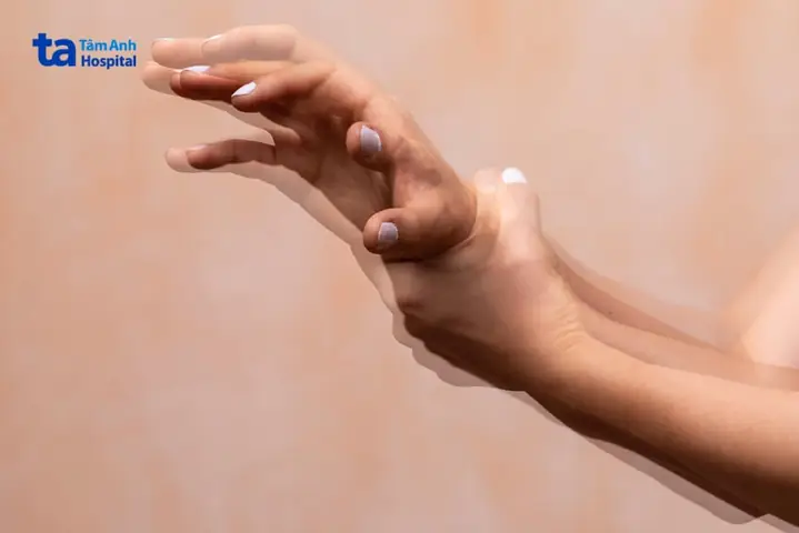 Rung Tay Là Bệnh Gì? Nguyên Nhân, Triệu Chứng Và Cách Xử Lý Đúng