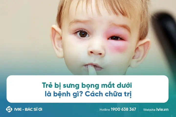 Sưng Bọng Mắt Dưới Ở Trẻ: Nguyên Nhân, Cách Xử Lý Và Phòng Tránh