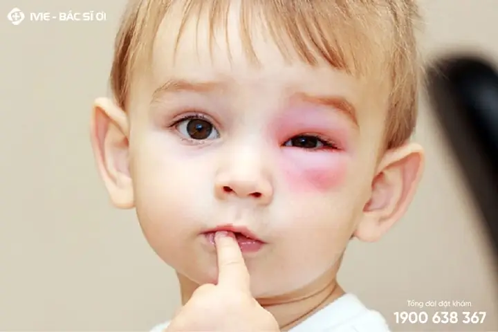 Sưng Bọng Mắt Ở Trẻ Em: Nguyên Nhân Và Cách Xử Lý Đúng Cách