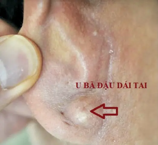 Tai Bị Sưng Bên Trong: Nguyên Nhân, Triệu Chứng Và Cách Xử Lý