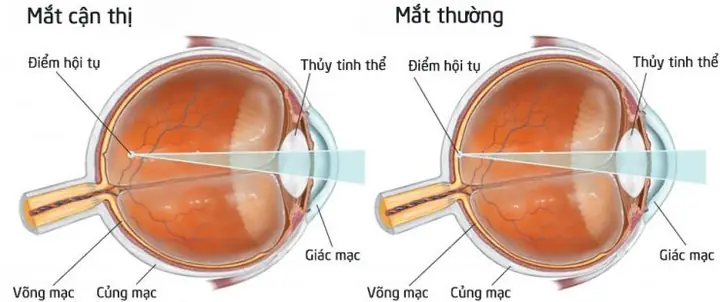 Cận Thị Là Gì? Tổng Quan Và Thông Tin Cần Biết
