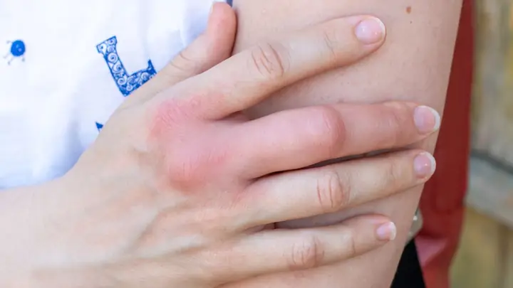 Tay Bị Sưng Phù Và Ngứa: Nguyên Nhân Và Cách Xử Lý Hiệu Quả