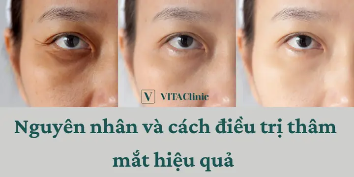 Thâm Quầng Mắt Nên Làm Gì? Hướng Dẫn 15 Bước Khắc Phục Hiệu Quả