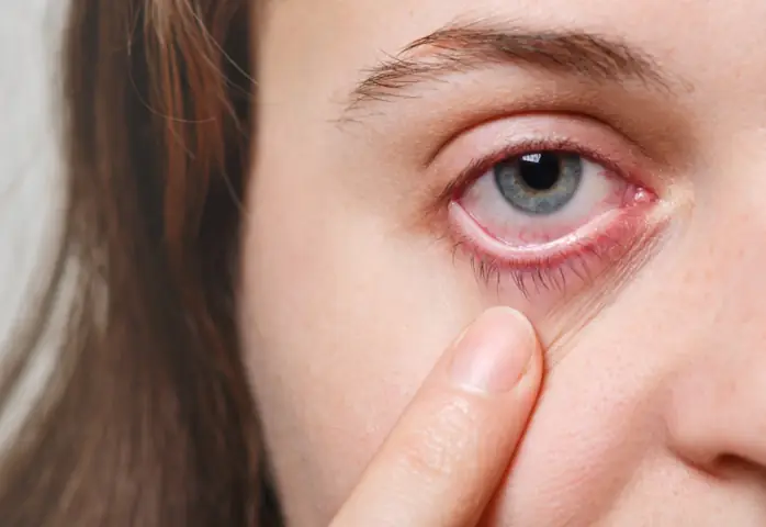 Thức Đêm Làm Mắt Bị Đỏ: Nguyên Nhân Và Cách Khắc Phục Hiệu Quả