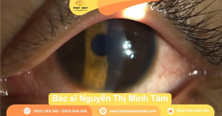 Tia Hàn Bắn Vào Mắt: Nguy Hiểm, Cách Xử Lý Và Phòng Tránh Hiệu Quả