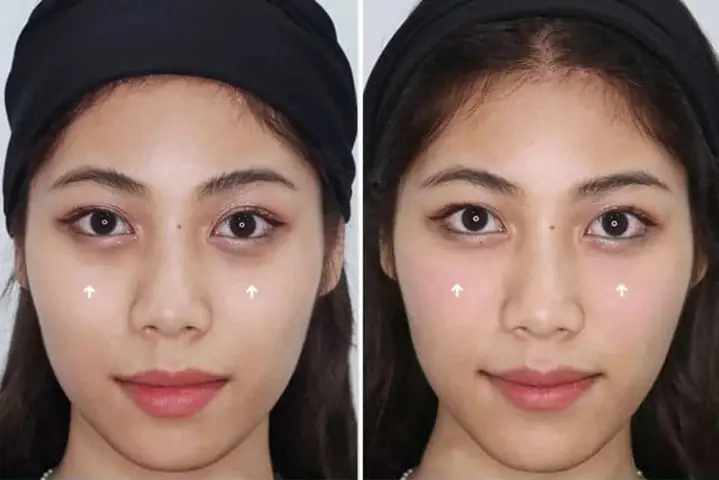 Đánh Giá Chi Tiết 5 Phương Pháp Tiêm Khử Thâm Quầng Mắt Hiệu Quả