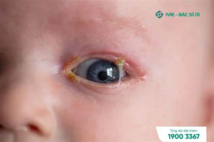 Trẻ Bị Ra Nhiều Gỉ Mắt Xanh: Nguyên Nhân Và Cách Xử Lý