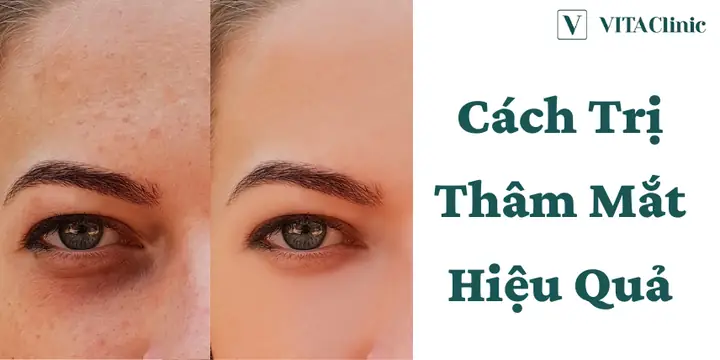 Trị Thâm Mắt Tại Nhà: Hướng Dẫn Chi Tiết Và An Toàn