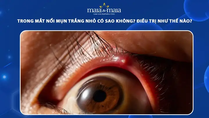 Mắt Nổi Mụn Trắng Nhỏ: Nguyên Nhân, Cách Xử Lý Hiệu Quả