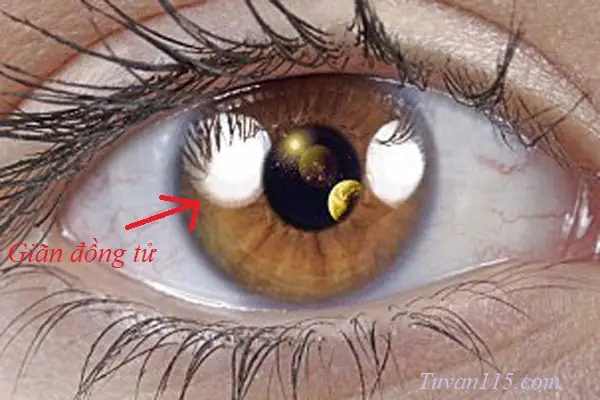 Trùng Đồng Tử Là Gì? Tổng Hợp Từ Nguyên Nhân Đến Cách Xử Lý