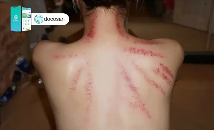 Trúng Gió Là Bệnh Gì? Phân Tích Từ Góc Độ Y Học Và Kinh Nghiệm Thực Tế