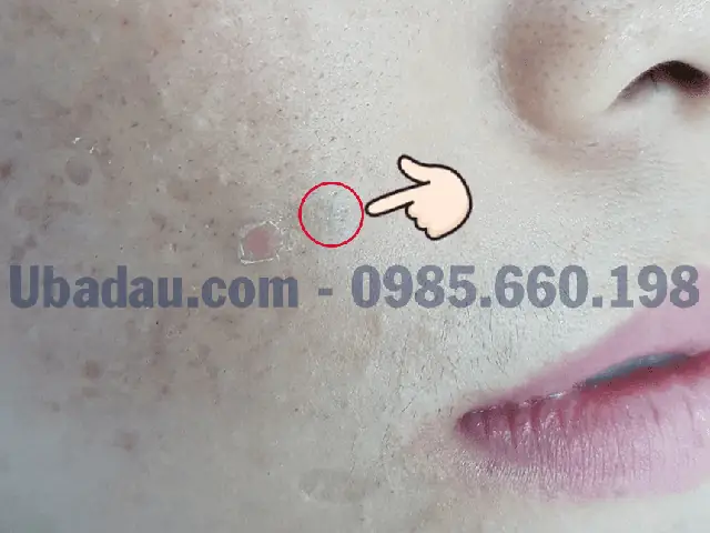 U Bã Đậu Ở Mặt: Nguyên Nhân, Triệu Chứng Và Cách Xử Lý Hiệu Quả