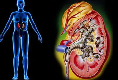 Viêm Thận Bể Thận Cấp: Tổng Hợp Từ Nguyên Nhân, Triệu Chứng Đến Biến Chứng