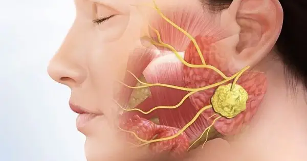 Viêm Tuyến Mang Tai: Nguyên Nhân, Triệu Chứng & Cách Phòng Tránh Toàn Diện