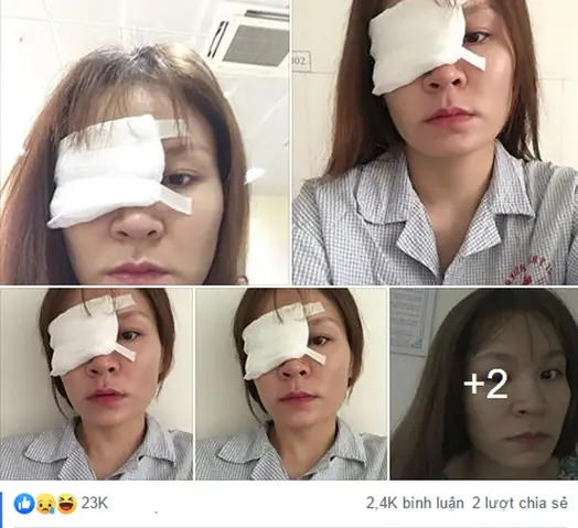 Bị Keo 502 Dính Vào Mắt