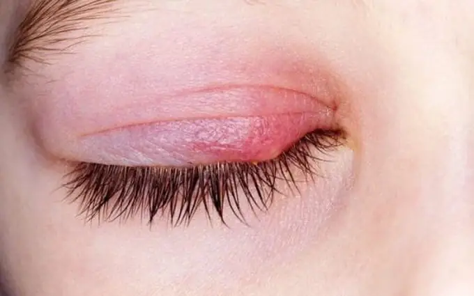 Bị Lẹo Mắt Có Lây Sang Người Khác Không