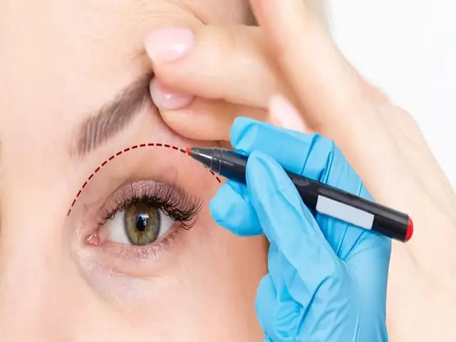Cắt Mí Mắt Sau Bao Lâu Đẹp Tự Nhiên? Lộ Trình Phục Hồi Từng Giai Đoạn
