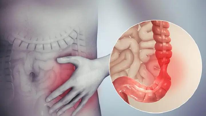 Co Thắt Đại Tràng Là Gì
