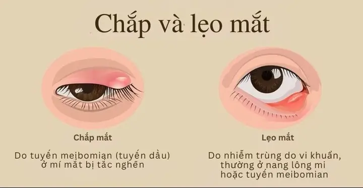 Dấu Hiệu Đặc Trưng Của Bệnh Chắp Lẹo Mắt Là