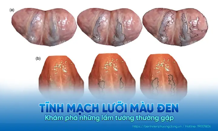 Dưới Lưỡi Có Gân Xanh