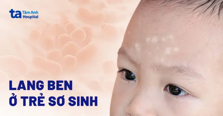 Lang Ben Ở Trẻ Sơ Sinh: Nguyên Nhân, Dấu Hiệu & Cách Phòng Ngừa Toàn Diện