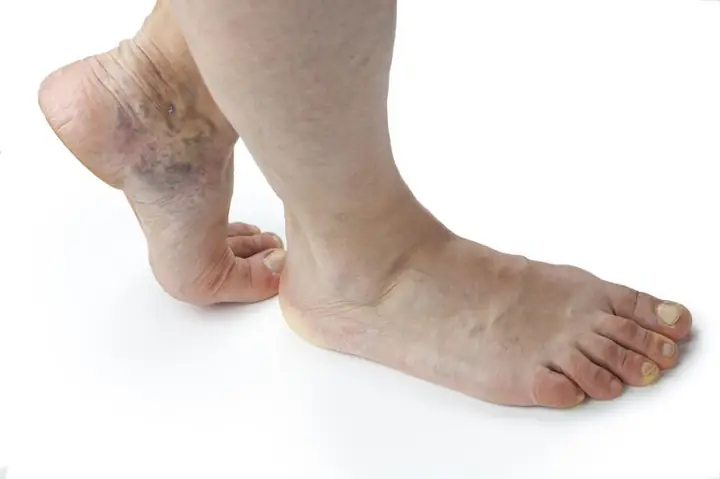 Mu Bàn Chân Nổi Gân Xanh