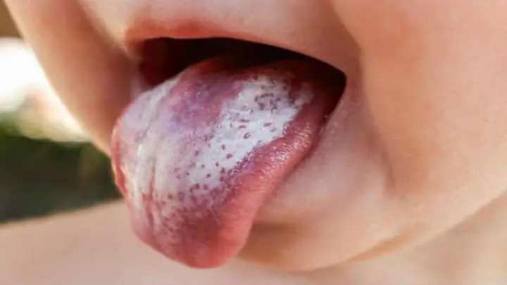 Nhiệt Lưỡi Ở Trẻ Em
