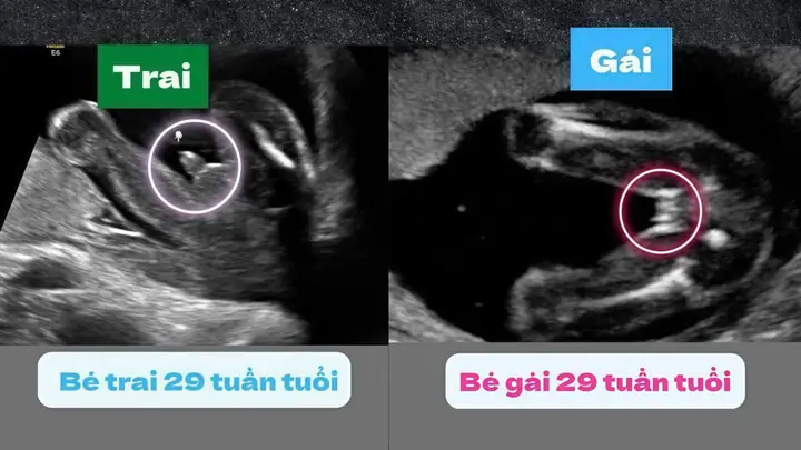 Nhìn Túi Thai Biết Trai Hay Gái