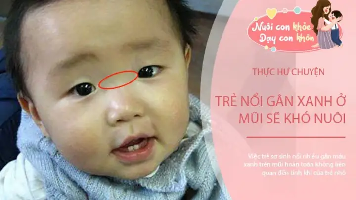 Trẻ Nổi Gân Xanh Trên Mặt