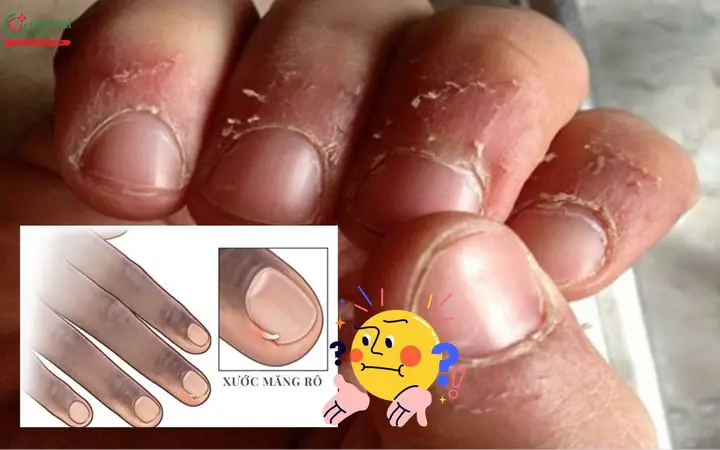Xước Măng Rô Là Thiếu Chất Gì